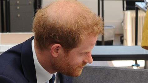 Balding Prince Harry visits a hair loss clinic for thickening ...