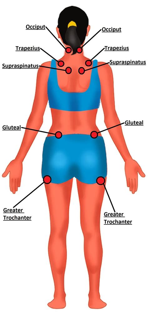 Fibromyalgia tender points on the back. | Fibromyalgia, Chronic fatigue facts, Fibromyalgia ...