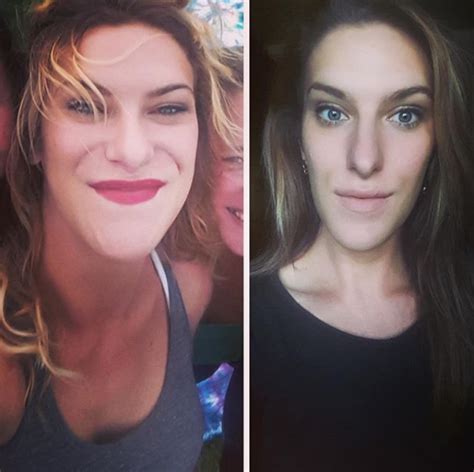 Woman's face grew due to rare hormonal disorder