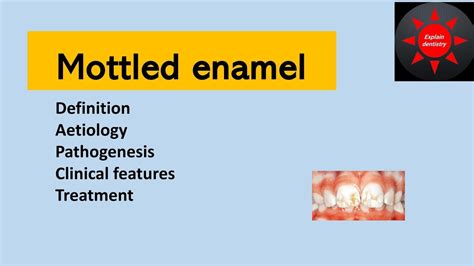 Mottled enamel - Oral pathology // Enamel hypoplasia due to fluoride// - YouTube