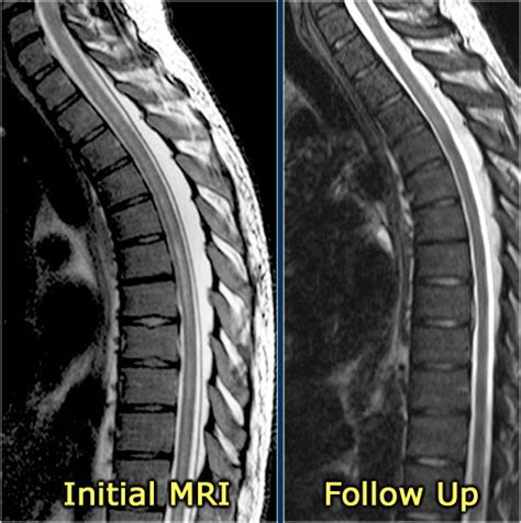 Transverse Myelitis Mri - The Radiology Assistant Myelopathy - Magnetic resonance imaging (mri ...