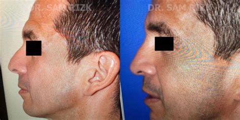 Doctor Rizk, New York, New York (10028) Man Treated With Rhinoplasty Procedure Photo ...