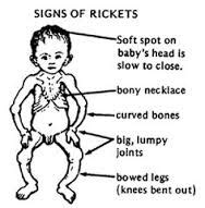 Rickets, a Vitamin Deficiency Disease that May Affect Preppers