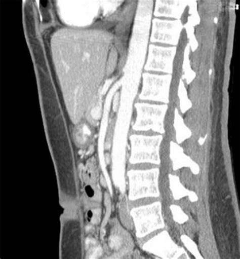 SMA Syndrome - The Operative Review Of Surgery