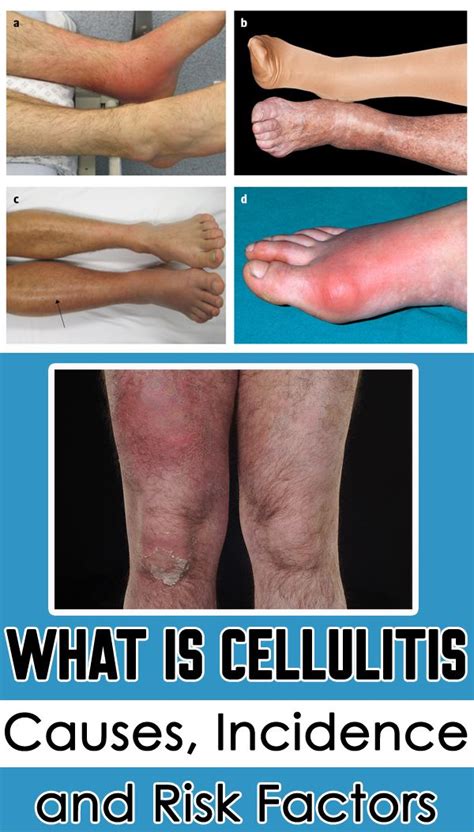 What is Cellulitis Causes, Incidence and Risk Factors - Getinfopedia.com | Risk factors ...