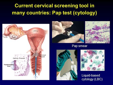 All about Cervical Cancer – Causes, Symptoms, Diagnosis, Treatment and ...