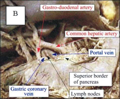 Common Bile Duct Diameter