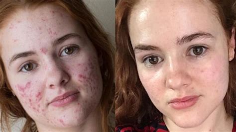 This Woman Documented Her Acne Transformation and the Before-and-After Accutane Photos Went ...