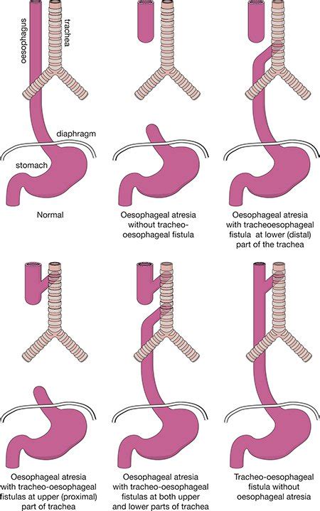 Esophageal Atresia Repair