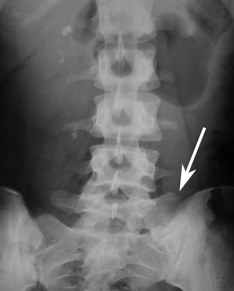 Lumbar sacralization