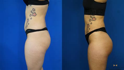 Before and After Pictures of Brazilian Butt Lift - Houston, TX Patch