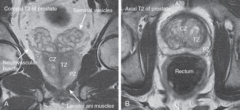 Prostate imaging | Radiology Key