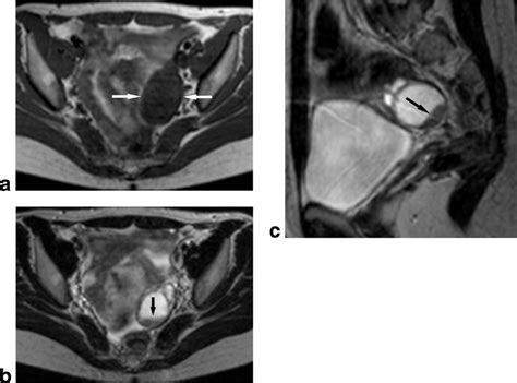 Hemorrhagic Ovarian Cyst Mri