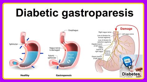 diabetic gastroparesis - YouTube