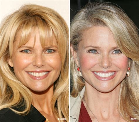 Hollywood's Best Botox | Celebrity skin secrets, Christie brinkley plastic surgery, Natural botox