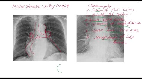 Mitral Stenosis X Ray