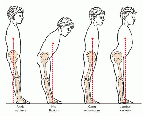 Ankle Equinus | Musculoskeletal Key