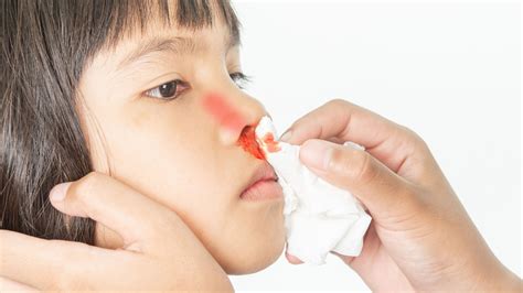 Nosebleeds in Children - What Causes Them and How to Handle Them at Home - Pediatric Heroes ...