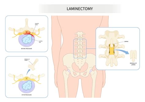 Exercises To Avoid After A Lumbar Laminectomy » FreakToFit