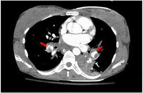 CT scan of the chest with contrast. The red arrows depict bilateral... | Download Scientific Diagram