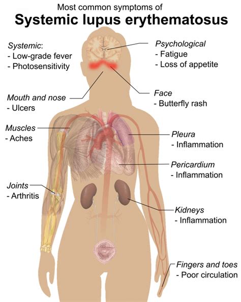 17.6 Disorders of the Immune System – Human Biology