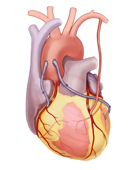 Bypass surgery- prolonged heart health - Avens Blog | Avens Blog