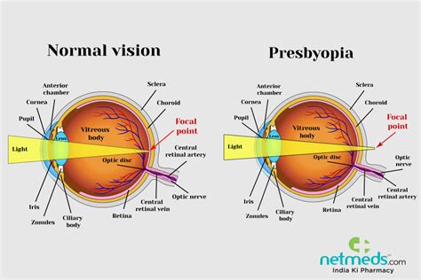 Presbyopia: Causes, Symptoms And Treatment