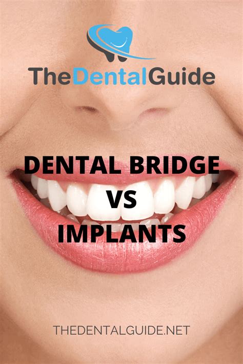 Dental Bridge vs Implants - The Dental Guide