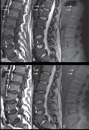 Ankylosing Spondylitis Mri