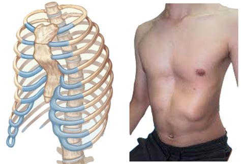 Thoracic Cage Pectus Excavatum Axial Skeleton Brachial Skeletal | Hot ...