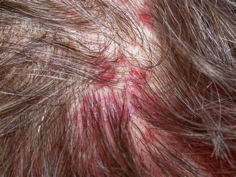 pilar cysts on scalp - pictures, photos