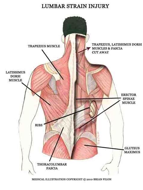 Back muscle strain diagnosis, posterior compartment muscles of the arm