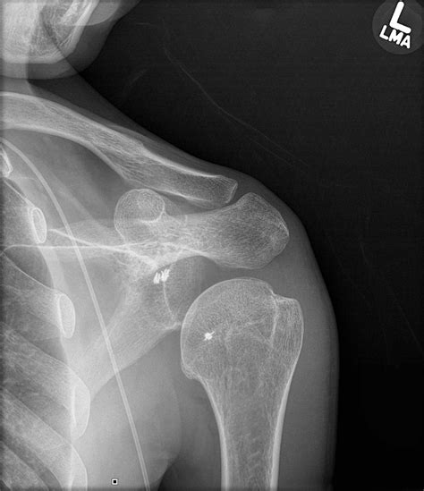 Cureus | Recurrent Shoulder Posteroinferior Subluxation Status Post Reverse Remplissage