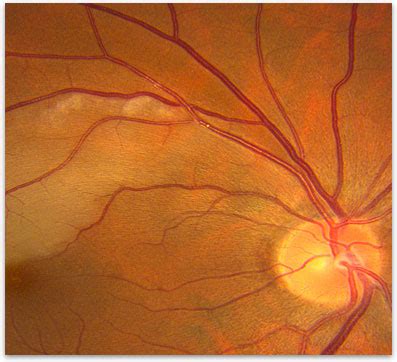 Retinal Artery Occlusion - Retina-Vitreous Surgeons of CNY