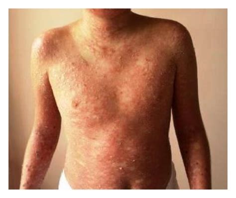 (a) Erythematous macules, papules, and pustules on the trunk. (b)... | Download Scientific Diagram
