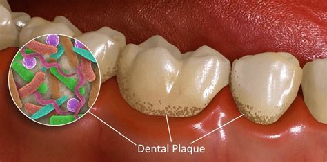dental-plaque-bacteria-2 – Kuipers Ortho