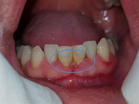 Necrotizing Periodontal Disease