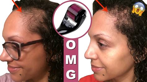 EVERYTHING YOU NEED TO KNOW ABOUT DERMA ROLLERS FOR HAIR LOSS!!! - YouTube