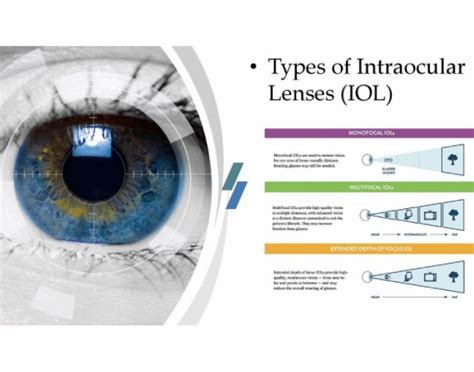 di riserva obiettato Cullare eye cataract lens types Perso aggrovigliamento Confezione da mettere