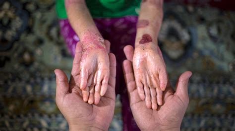 Epidermolysis Bullosa: Symptoms, Causes, and Treatments