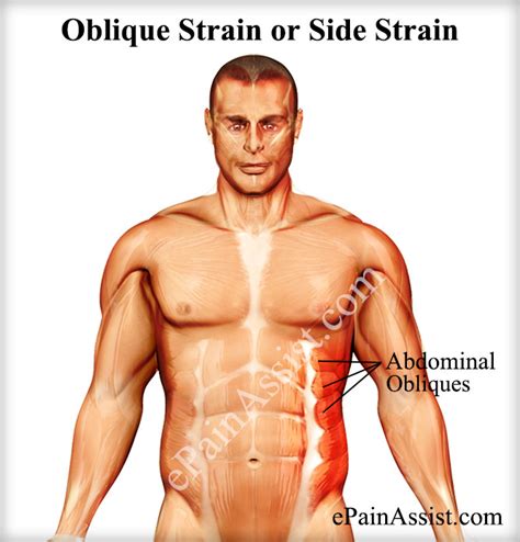 Oblique Strain or Side Strain|Causes|Symptoms|Treatment|Recovery Period