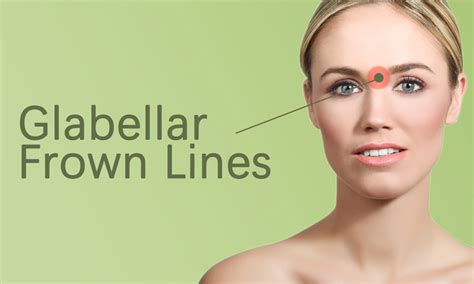 Glabellar Lines Fillers Treatment in Surat, Gujarat (India)