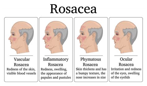 Best Essential Oil And Recipes For Rosacea Skin | Essential Oil Benefits