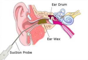 Microsuction Earwax Removal