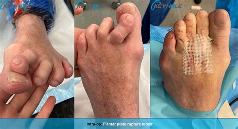 Plantar Plate Tear - Perth Podiatric Surgery