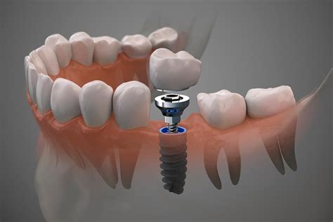 ¿Duelen los implantes dentales? - Clínica Dental Arrasate