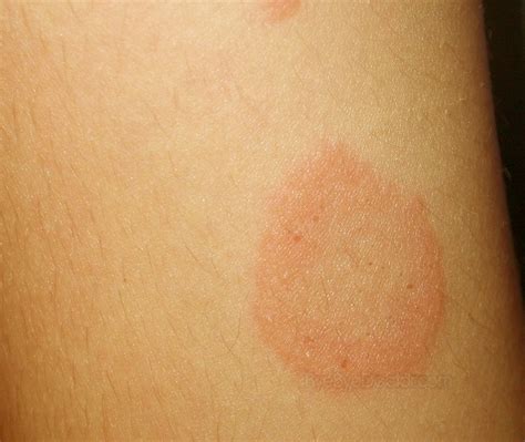 What Are the Stages of Pityriasis Rosea? | New Health Advisor