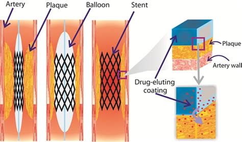 Different Types of Stents - Translumina Therapeutics