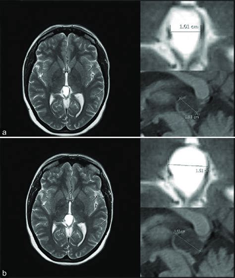 Pineal cyst growth during follow-up, from 1 × 1.5 cm (a) to 1.5 × 1.9 ...