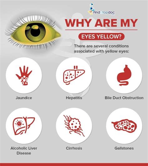 Why Are My Eyes Yellow and What Do Yellow Eyes Indicate?